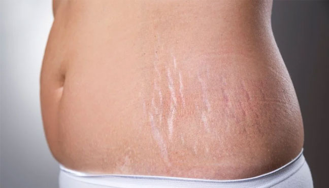 درمان ترک پوستی با لیزر فوتونا