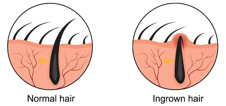 1. Causes of ingrown hair - wide 9