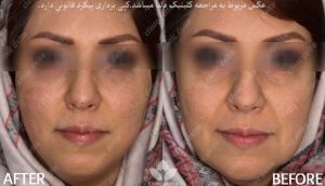 لیفت پوست صورت با نخ- درمان چین و چروک