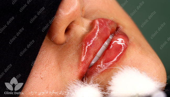 بوسیدن بعد از تزریق ژل لب