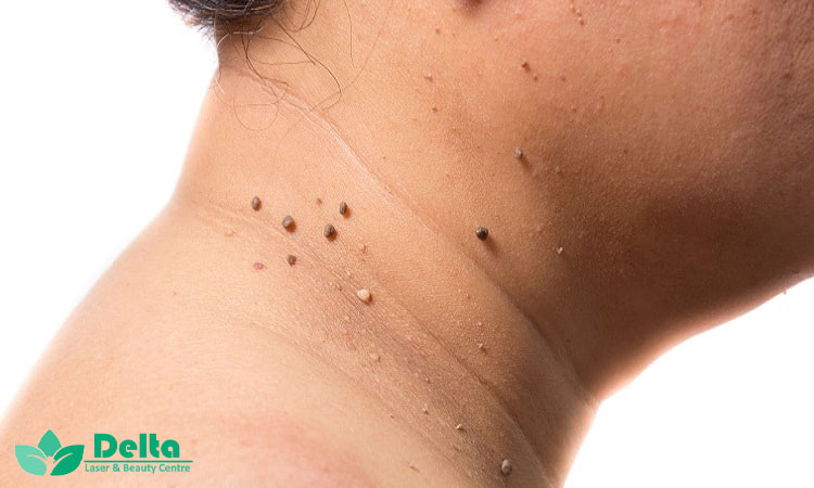 درمان های زائده گوشتی کدامند؟