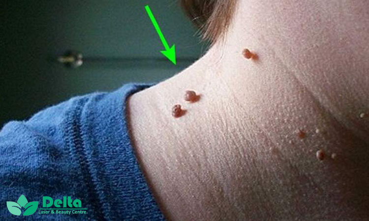 کدام بخش های بدن بیشتر درگیر زائده های گوشتی می شوند؟