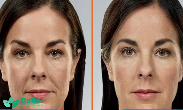 درمان ترک پوستی با مزوتراپی در کلینیک دلتا لیزر