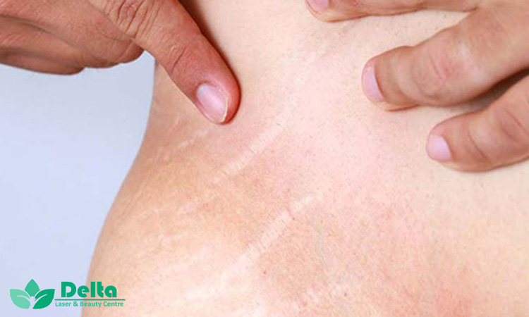 مزایای درمان ترک پوستی با مزوتراپی