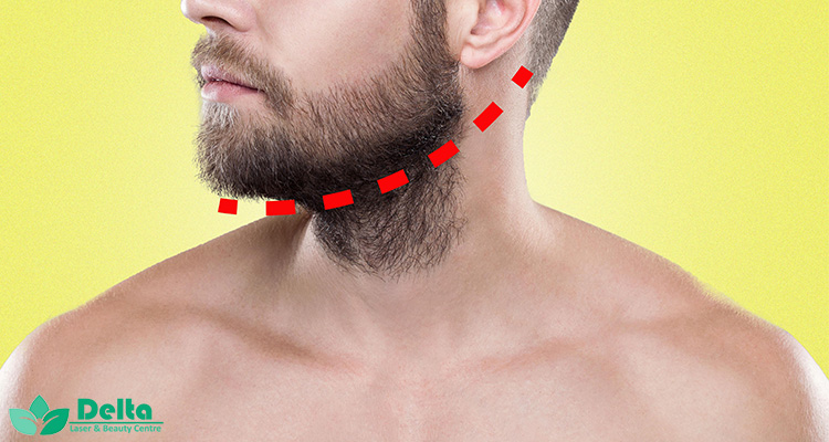 تاثیر لیزر موی مردانه و خط ریش در آقایان