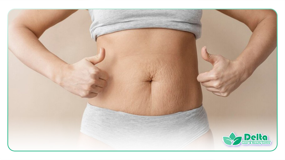 تصویری از ترک شکم