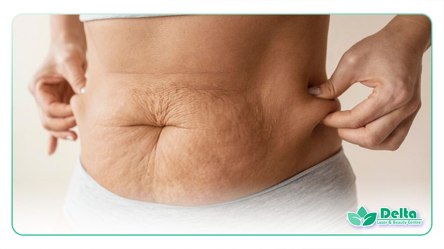 تصویری از ترک شکم