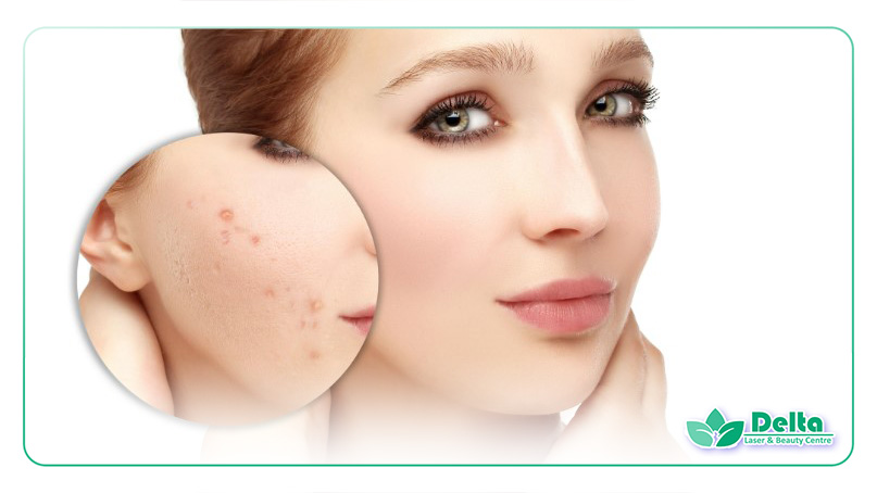 تصویری از زنی زیبا در حال رفع تیرگیهای پوستی خود با لیزر کیوسوئیچ هلیوس