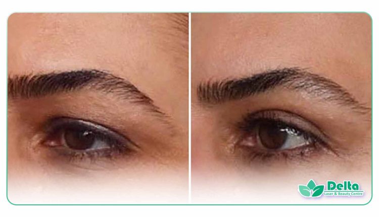 آیا تزریق بوتاکس باعث لیفت شقیقه می شود؟