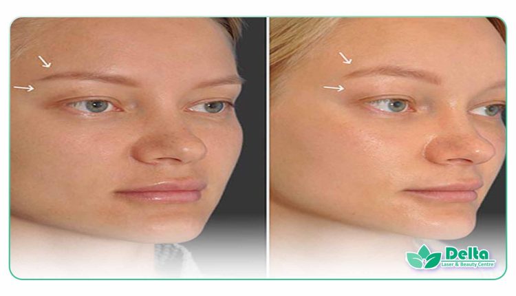 آیا تزریق بوتاکس باعث لیفت شقیقه می شود؟