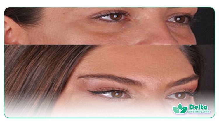 آیا تزریق بوتاکس باعث لیفت شقیقه می شود؟