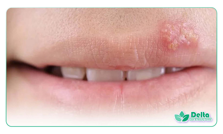 تبخال بعد از تزریق ژل لب