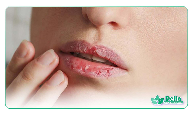 تبخال بعد از تزریق ژل لب | علل و درمان
