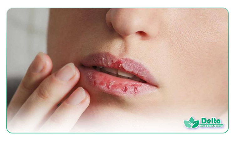 نکات مهم غذا خوردن بعد ژل لب