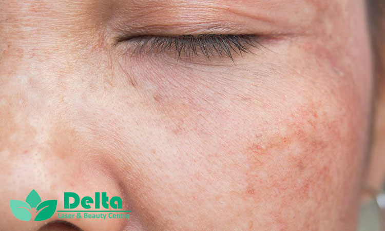 پیلینگ لیزری