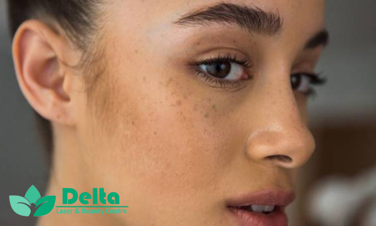 پیلینگ لیزری