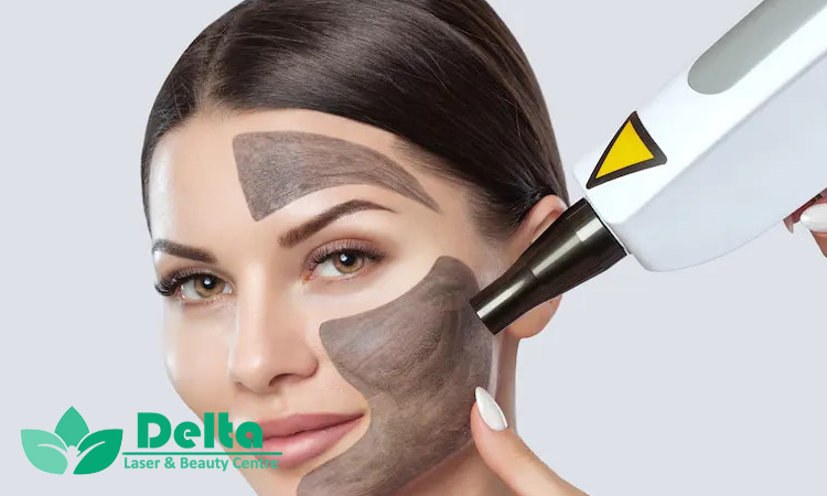 پیلینگ لیزری