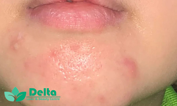 علت اصلی جوش روی چانه چیست؟