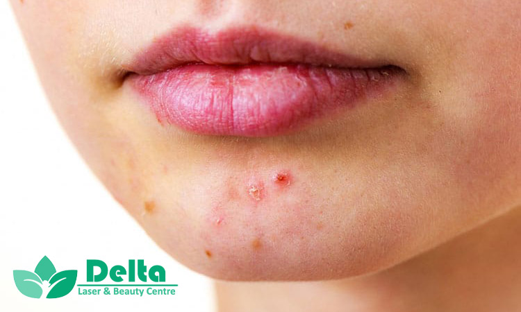 علت اصلی جوش روی چانه چیست؟