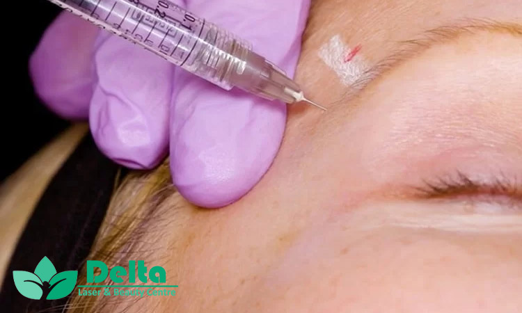 بهترین ژل برای شقیقه چیست؟