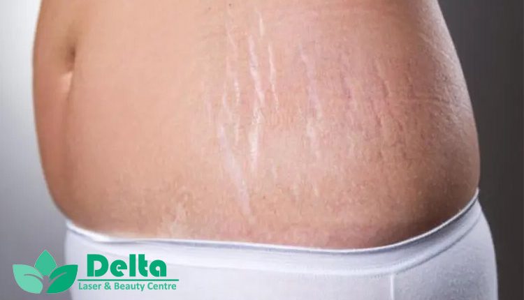 ترکهای پوستی ارثی هستند؟ یا قابل درماناند؟