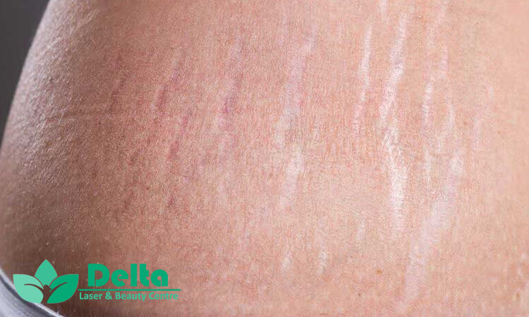 ترک‌های پوستی ارثی هستند؟ یا قابل درمان‌اند؟