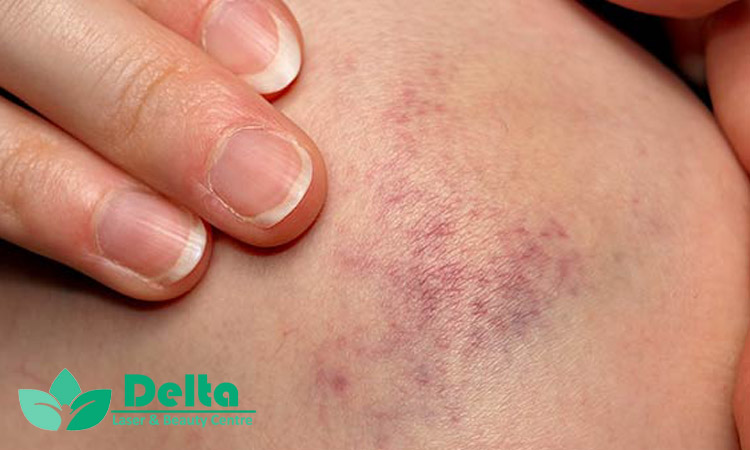 آیا لیزر باعث سوختگی یا آسیب به پوست می‌شود؟