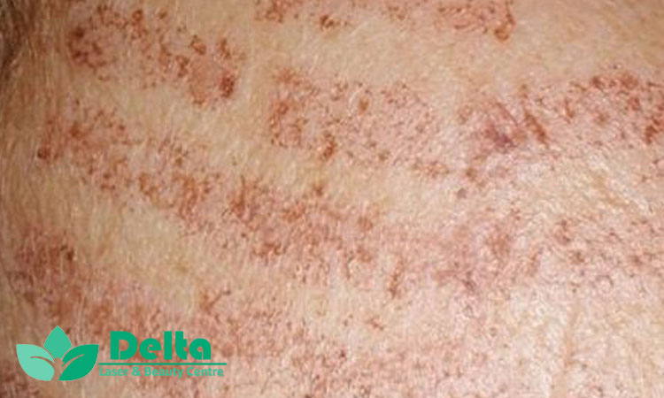 آیا لیزر باعث سوختگی یا آسیب به پوست می‌شود؟