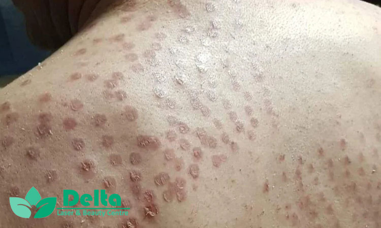 آیا لیزر باعث سوختگی یا آسیب به پوست می‌شود؟