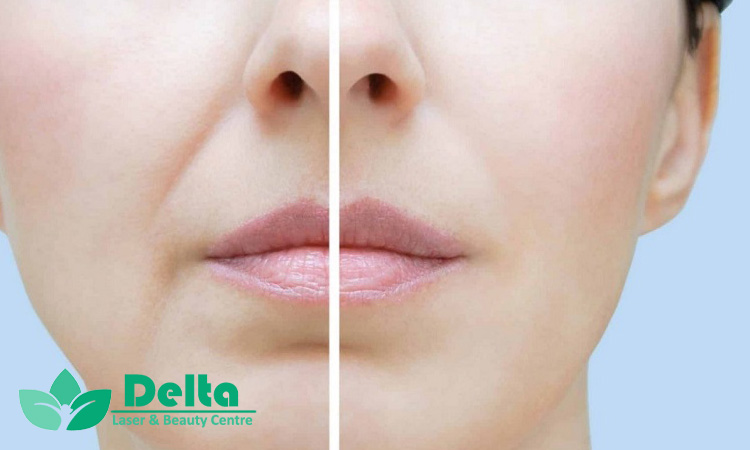 چرا ژل خط خنده بهترین راه جوانسازی صورت است؟