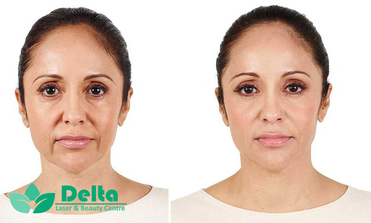 چرا ژل خط خنده بهترین راه جوانسازی صورت است؟