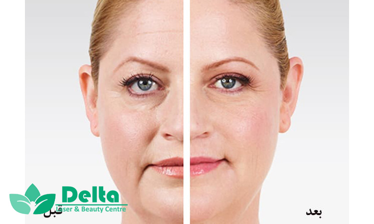 چرا ژل خط خنده بهترین راه جوانسازی صورت است؟