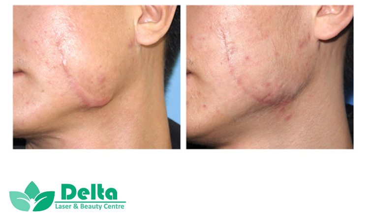 لیزر جای زخم برای پوست سبزه و تیره