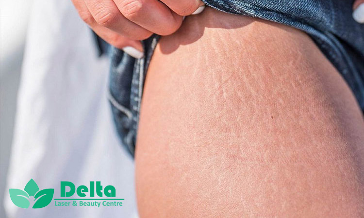 ترک پوستی تازه با قدیمی فرق داره؟