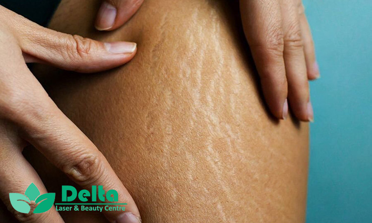 ترک پوستی تازه با قدیمی فرق داره؟