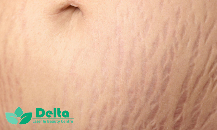 ترک پوستی تازه با قدیمی فرق داره؟