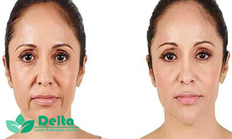 تفاوت تزریق سطحی و عمقی ژل در ناحیه خط خنده