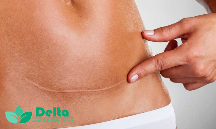 چرا بعضی جای بخیهها گود میشوند؟