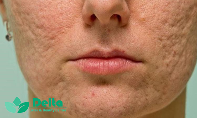 چرا بعضی جای بخیهها گود میشوند؟