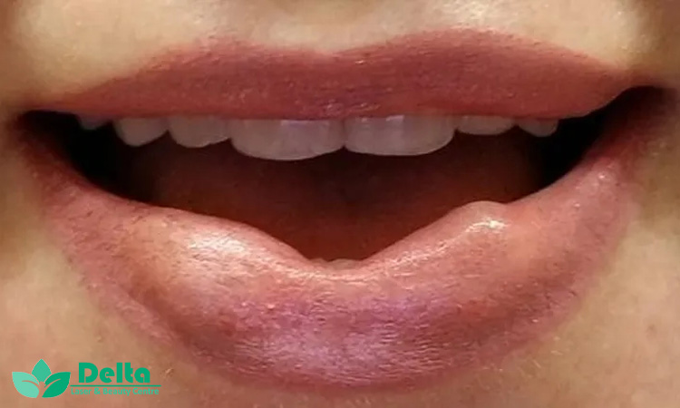 چرا ژل لب بعضیها مچاله میشود؟