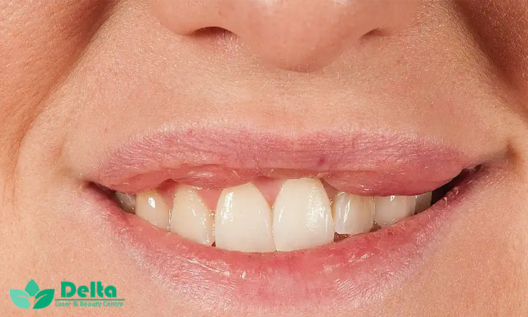 چرا ژل لب بعضی‌ها مچاله می‌شود؟