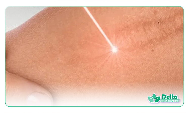 لیزر جای زخم در نوجوانان