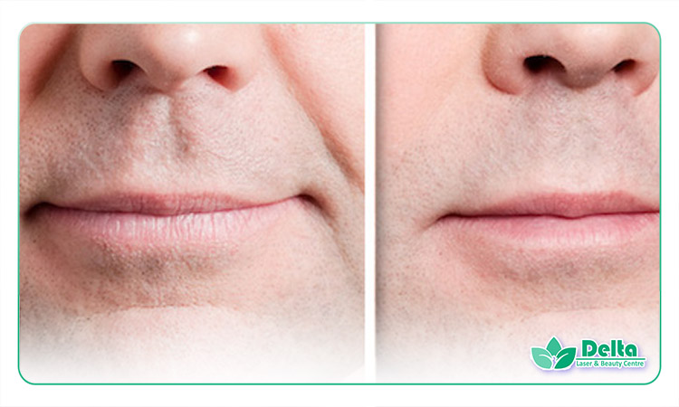 تزریق ژل خط خنده در مردان