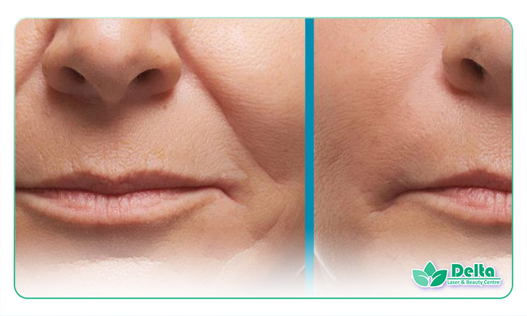 تزریق ژل خط خنده در مردان