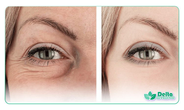 تفاوت فیلر گونه و چربی تزریقی