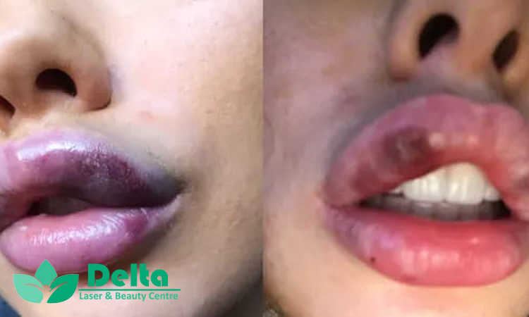 آیا ژل لب باعث افتادگی لب می شود؟