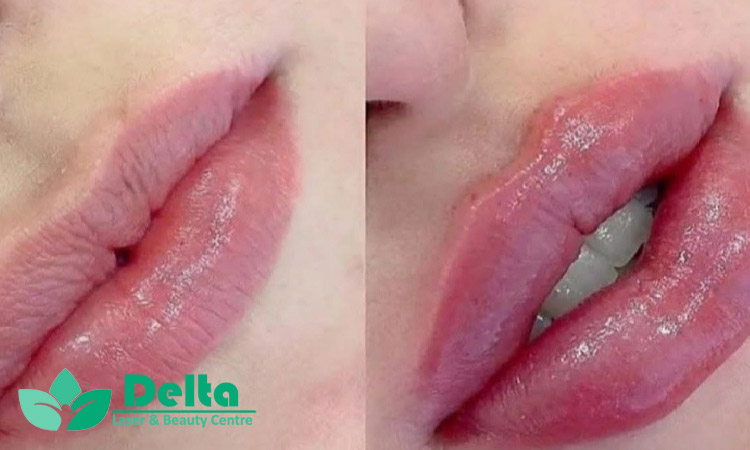 آیا ژل لب باعث افتادگی لب می شود؟