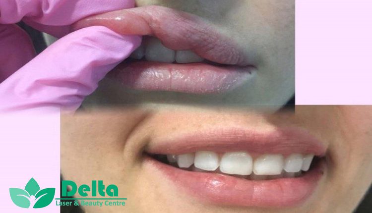 آیا ژل لب باعث افتادگی لب می شود؟