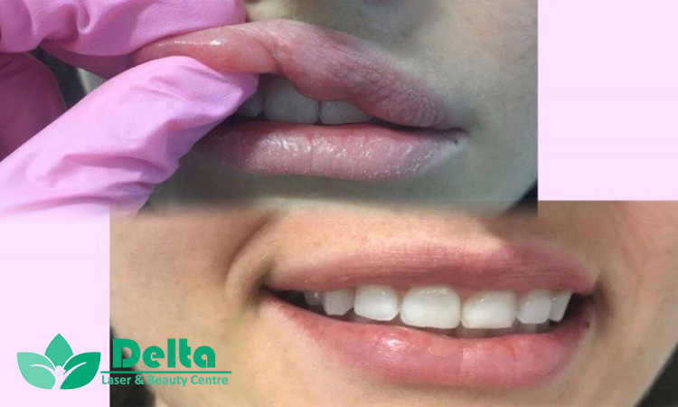 آیا ژل لب باعث افتادگی لب می شود؟