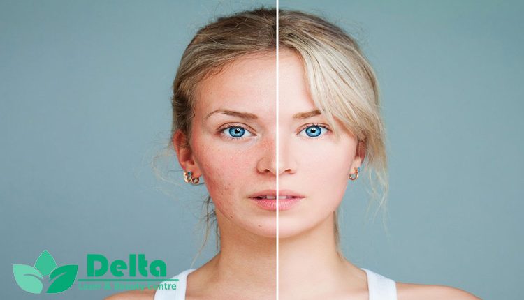 ورزش های صورت برای کاهش جای جوش